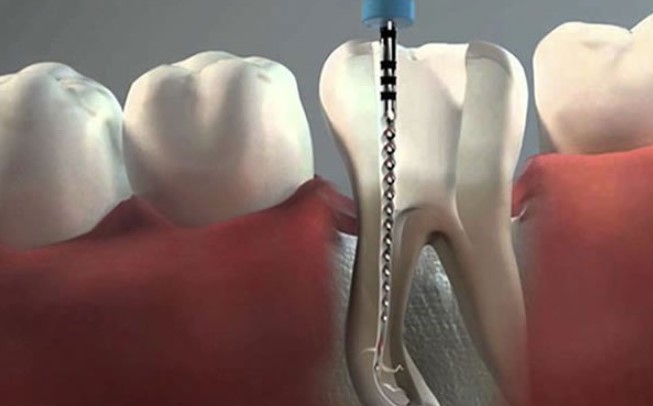por qué hacer una ortodoncia
