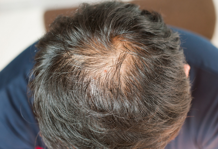 tatuaje imitando pelo resindificacion